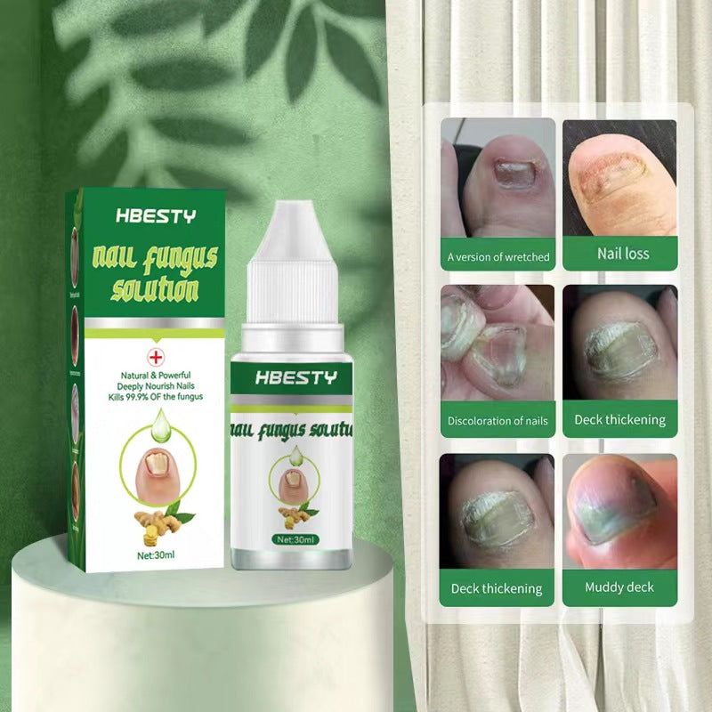 Tratamiento para Hongos de Uñas Cuidado de Pies Gel Removedor de Hongos de Uñas de Pies y Manos Antinfección Paroniquia Onicomicosis