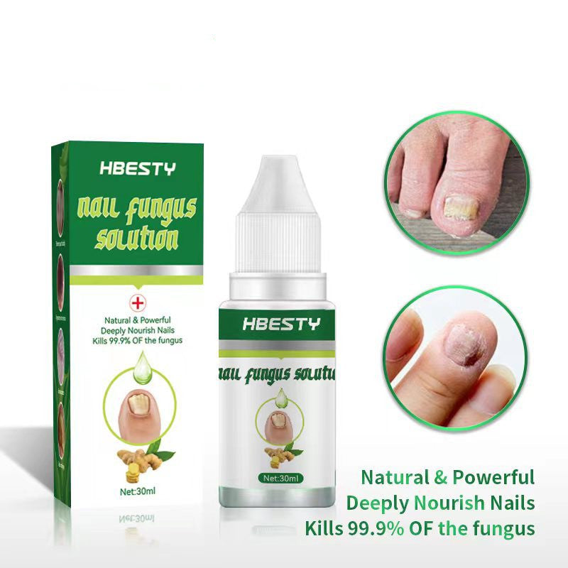 Tratamiento para Hongos de Uñas Cuidado de Pies Gel Removedor de Hongos de Uñas de Pies y Manos Antinfección Paroniquia Onicomicosis